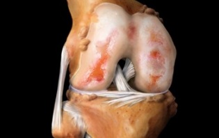 Что такое остеоартроз колена